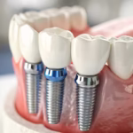 implanty zębowe