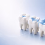 Onlay, inlay, overlay