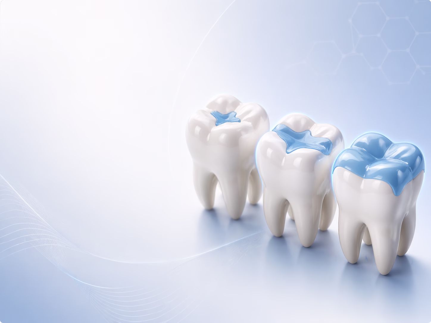 Onlay, inlay, overlay